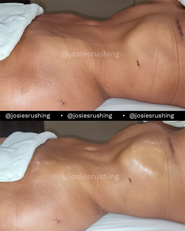 Before and after - Post Surgery