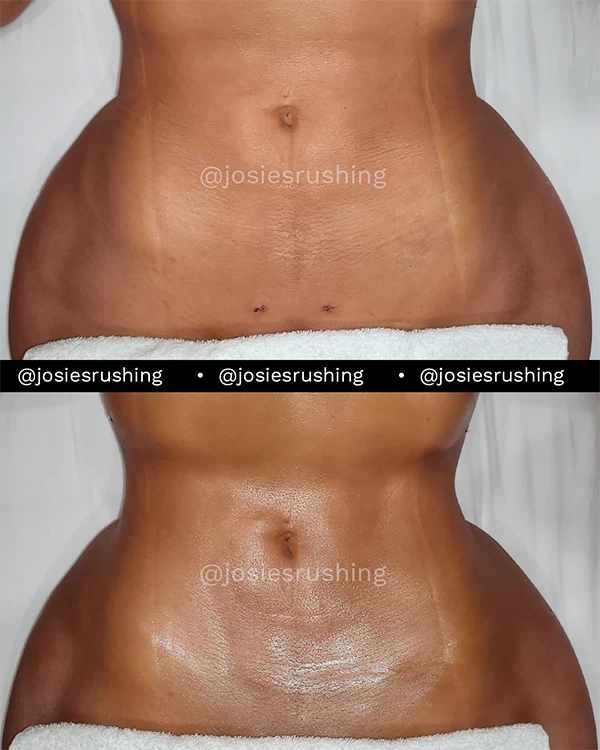 Before and after - Post Surgery