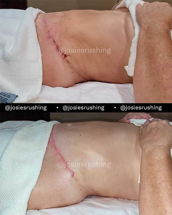 Before and after - Post Surgery