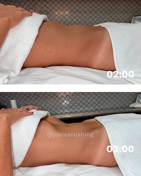 Before and After - Brazilian Body Lymphatic