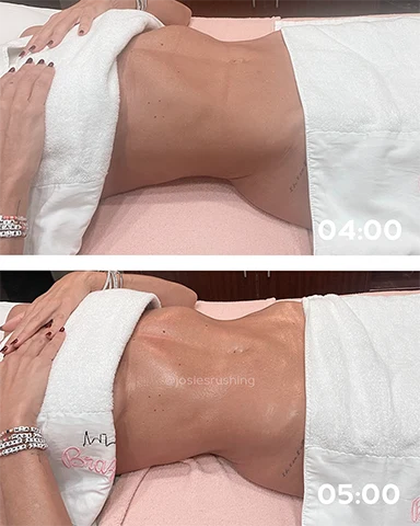 Before and After - Brazilian Body Lymphatic Drainage Massage