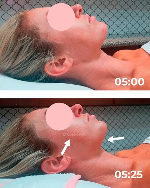 Before and After - Brazilian Face Lymphatic