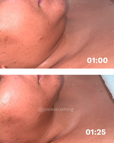 Before and After - Brazilian Face Lymphatic