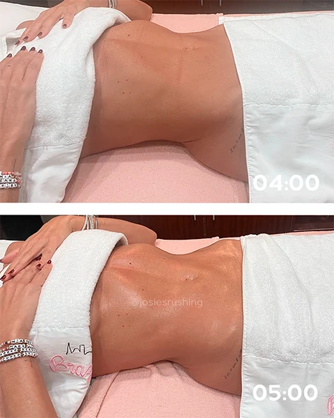 Before and After - Brazilian Body Lymphatic