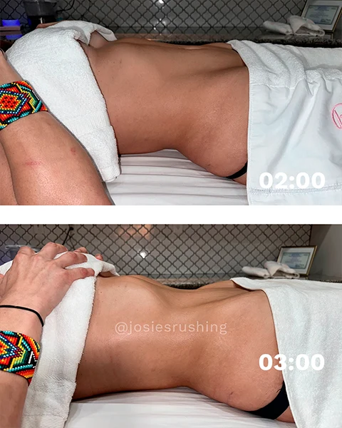 Before and After - Brazilian Body Lymphatic