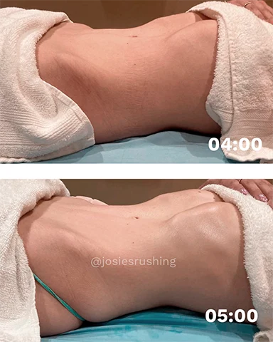 Before and After - Brazilian Body Lymphatic Drainage Massage
