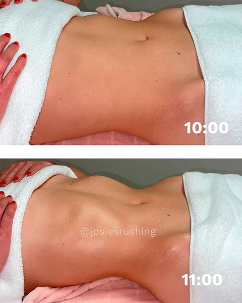 Before and After - Brazilian Body Lymphatic