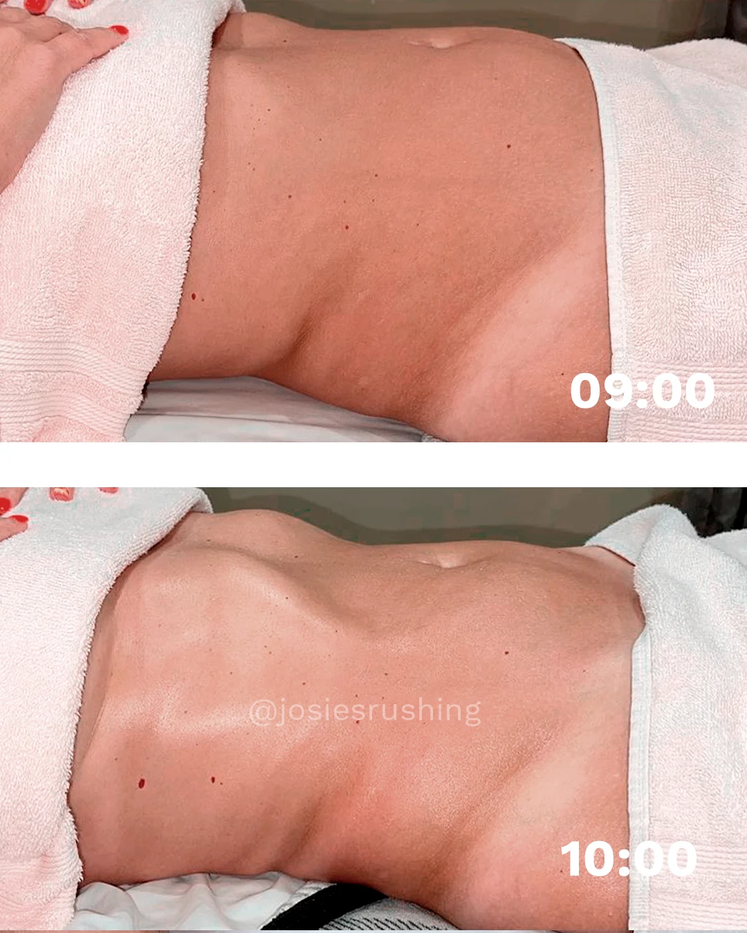 Before and After - Brazilian Body Lymphatic Drainage Massage