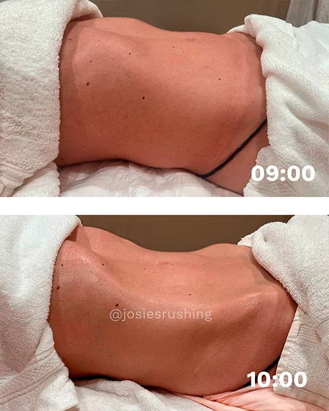 Before and After - Brazilian Body Lymphatic