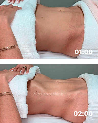 Before and After - Brazilian Body Lymphatic Drainage Massage