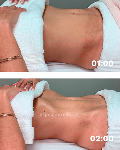 Before and After - Brazilian Body Lymphatic