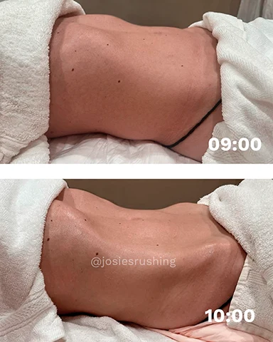 Before and After - Brazilian Body Lymphatic Drainage Massage