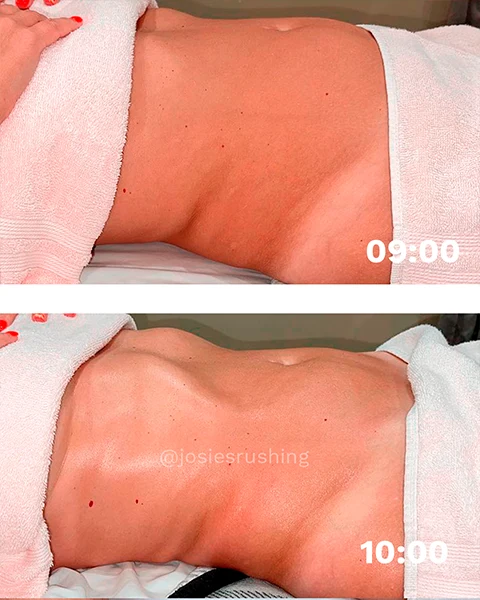 Before and After - Brazilian Body Lymphatic