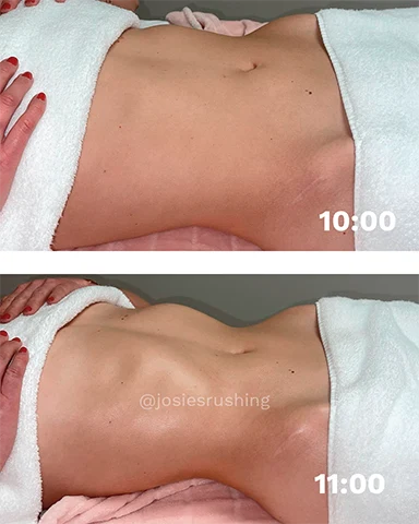 Before and After - Brazilian Body Lymphatic Drainage Massage