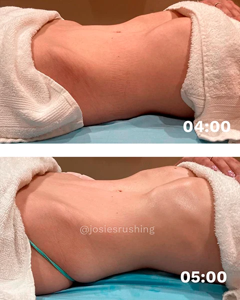Before and After - Brazilian Body Lymphatic