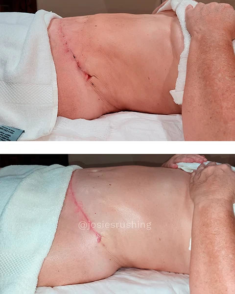 Before and After - Brazilian Post Surgery Lymphatic