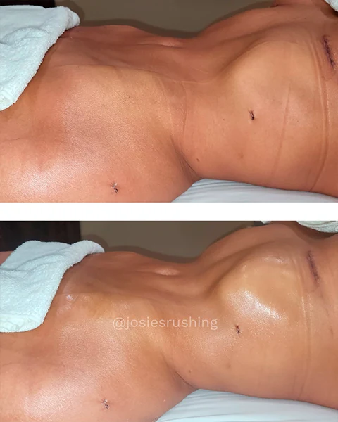 Before and After - Brazilian Post Surgery Lymphatic