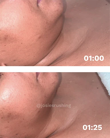 Before and After - Brazilian Face Lymphatic Drainage Massage