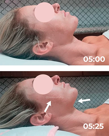 Before and After - Brazilian Face Lymphatic Drainage Massage