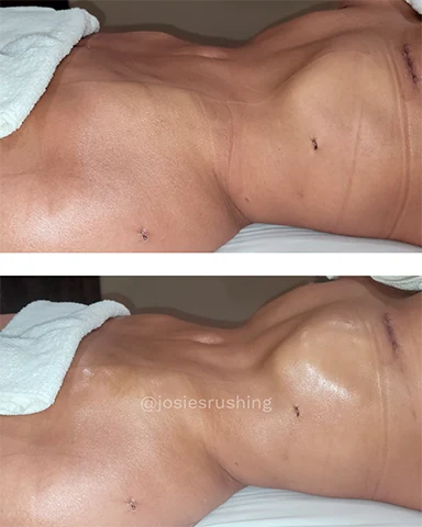 Before and After - Brazilian Post Surgery Lymphatic Drainage Massage