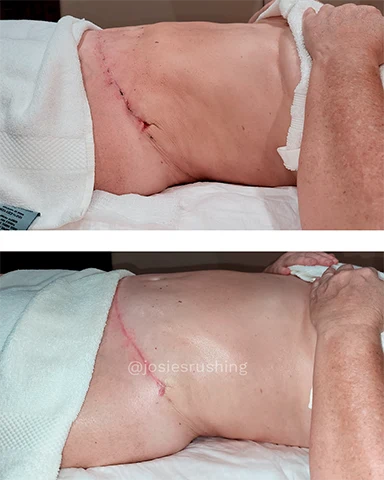 Before and After - Brazilian Post Surgery Lymphatic Drainage Massage