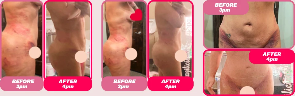 Before and after - Post Surgery