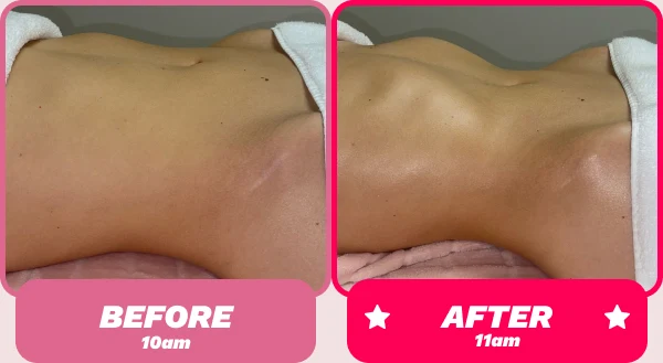 Before and after - Brazilian Body Lymphatic Drainage Massage